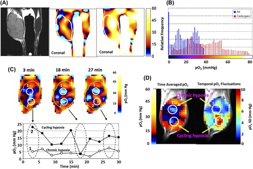 Figure 2. (A) In vivo EPR oxygen mapping of SCC tumor-bearing mouse leg, and visualization of the effect of carbogen (95% O2 plus 5% CO2) breathing on tumor pO2. (B) Histograms of pO2 in the tumor region of the same mouse breathing medical air (blue) and carbogen (red). A net increase in the median pO2 was noted upon carbogen breathing. (see [Citation24]). (C) Non-invasive imaging of chronic and cycling tumor hypoxia in a mouse implanted with a SCCVII tumor. 3D-EPR oxygen images were obtained every 3 min during a 30 min time window. Three representative images acquired at 3, 18, and 27 min are shown. Two ROIs were selected in the tumor (1 and 2), and pO2 was assessed in the ROIs over 30 min. (D) ROI 1 (open circles) indicates a chronically hypoxic region; ROI 2 (closed circles) represents a cycling hypoxic region showing temporal fluctuations in pO2. C, Time-averaged pO2 map (left) and standard deviation map of pO2 (right) calculated from the 10 images taken in the 30 min time window (see [Citation19]).