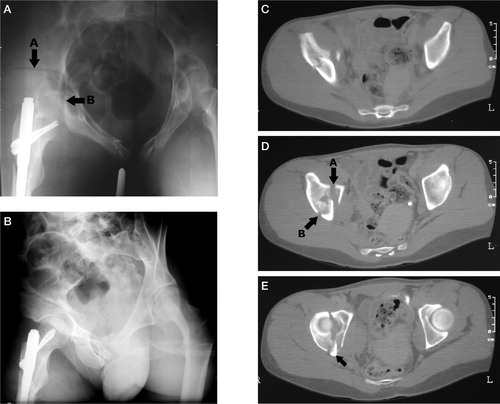 Figure 5. The transverse fracture with a floating acetabular dome is shown. In panel A with the pelvis inlet view, arrow A points to the vertical fracture line. Arrow B marks the transverse fracture line. (The inlet view is not part of standard radiographic examination of acetabular fractures.) In panel B, the iliac view clearly shows the vertical fracture line. The vertical line is also obvious on the axial CT-scan shown in panel C. Arrow A in panel D points to the start of the transverse fracture and arrow B shows the vertical fracture line. The scan is just proximal to the dome. In panel E, the arrow points to ileum connected to the IS-joint. No part of the acetabulum is attached to the axial skeleton.