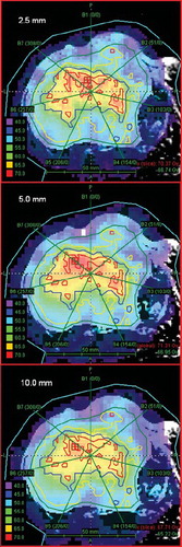 Figure 1. Coronal CT images through the central part of the tumour, with dose distribution as overlay for the seven fields and seven step-and-shoot intensity levels dose plan. Top image: 2.5 mm MLC. Middle image: 5 mm MLC. Bottom image: 10 mm MLC. Contour colours, with prescribed dose in brackets: Compartment 1: green (48.1 Gy), Compartment 2: yellow (53.8 Gy), Compartment 3: blue (63.4 Gy), Compartment 4: red (70.3 Gy).