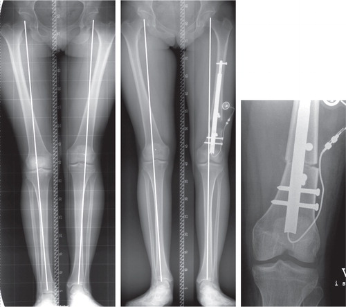 Figure 3. A patient in the nail group (pair 7). Preoperative deformity parameters included shortening and a slightly valgus deformity. Lengthening along the anatomical axis would have increased the valgus deformity. Intraoperative varisation was necessary for axis correction and to achieve a perfect mechanical axis after lengthening was completed.