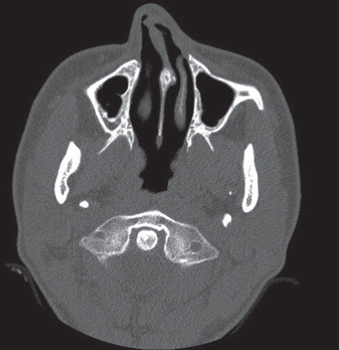 Figure 2. Computed tomography image of the septum deviation causing nasal breathing impairment.