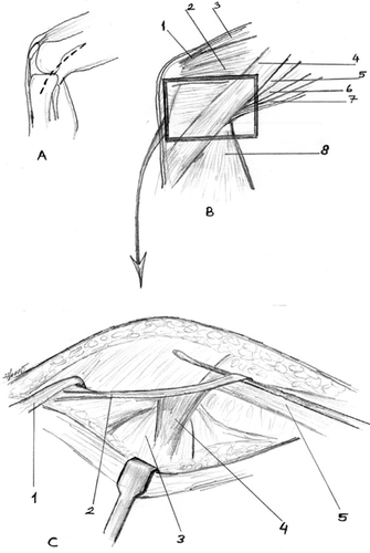 Figure 1. Drawing of anatomical dissection. A. Skin incision. B. Gross anatomical structures of the medial part of the knee. 1: quadriceps tendon; 2: vastus medialis muscle; 3: quadriceps muscle; 4: sartorius muscle; 5: semimembranosus muscle; 6: gracilis muscle; 7: semitendinosus muscle; 8: medial head of the gastrocnemius muscle. C. Schematic illustration of the cadaveric dissection specimen. 1: gracilis muscle is cut and reflected; 2: tendon of semitendinosus muscle; 3: medial head of the gastrocnemius muscle; 4: vincula; 5: semimembranosus muscle.