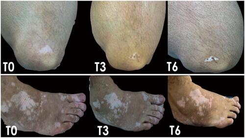 Figure 2. The repigmentation in the LL and foot of a male patient after 3 months and 6 months of treatment with tacrolimus 0.1% ointment (combined with VBUVB).