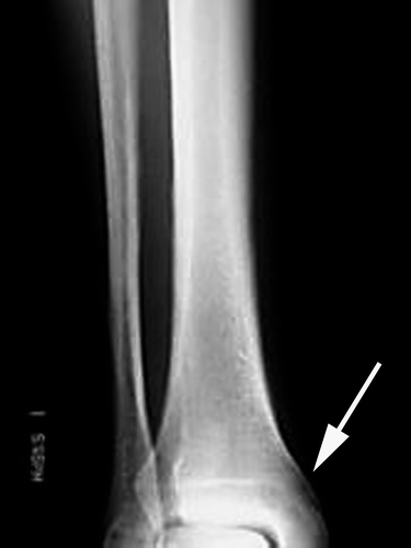 Figure 2.  Plain x-ray of tibia and fibula showing cortical elevation typical of hypertrophic osteoarthropathy.