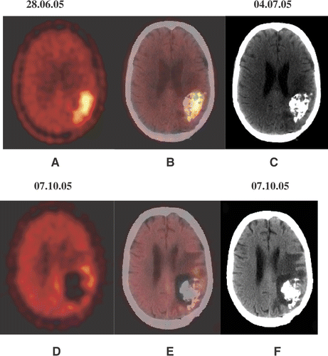 Figure 2. A 44-year-old female patient (No. 6) with recurrent glioblastoma in the left occipital lobe, showing an increased amino acid accumulation (A). CT examination (C), performed 1 day after PET-guided injection of nanoparticles and the fused PET/CT scan (B) allow assessment of their distribution. The control examinations 13 weeks after nano cancer therapy (D–F) show a significant reduction in the amino acid accumulation (PET) and building of necrotic/oedematous zones around the nanoparticles deposits (CT).