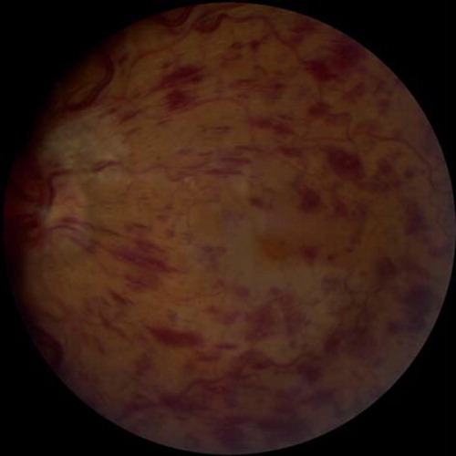 Figure 1. Characteristic diffuse flame-shaped hemorrhages and edema in the posterior pole in a patient with central retinal vein occlusion.