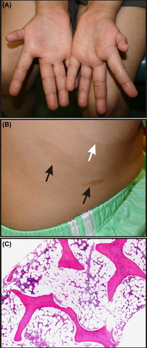 Figure 1. Phenotypic features of Fanconi anemia (FA). (A) Hypoplastic thumbs in an 11-year-old. (B) Hypopigmented (white arrow) and hyperpigmented (black arrows) skin lesions on the trunk of an adolescent. Photograph courtesy of Susan J. Bayliss, MD. (C) Progressive aplastic anemia in a 20-year-old with FA. Most of the marrow space is occupied by fat.