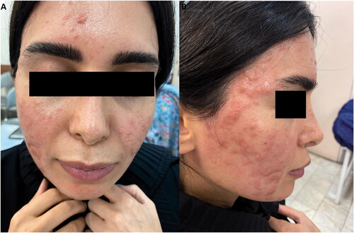 Figure 1. Erythematous papular lesions on the face.