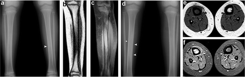 Figure 1. (a) Radiograph demonstrating a subtle periosteal reaction in the midshaft of the left tibia (arrowhead). (b) A coronal T1-weighted sequence showing loss of normal fatty marrow in the tibia. (c) A post-contrast fat-suppressed coronal T1-weighted image revealing contrast enhancement in the marrow and adjacent soft tissues. (d) Radiograph showing a periosteal reaction (arrowheads) and medullary sclerosis of the right tibia. (e) An axial T1-weighted image demonstrating reduced bone marrow signal of the right tibia with adjacent soft tissue intensity. (f) A post-contrast fat-suppressed axial T1-weighted image revealing contrast enhancement in the marrow and juxtacortical soft tissue enhancement in the right tibia.