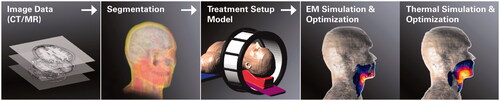 Figure 1. Schematic workflow for EM-HTP, using head and neck hyperthermia as an example. In US-HTP, the EM simulation and optimisation step is replaced by US simulation and optimisation.
