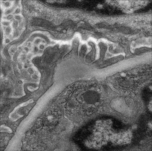 FIGURE 2. Electron microscopy shows large subepithelial hump-shaped electron dense deposition (original magnification × 8000).