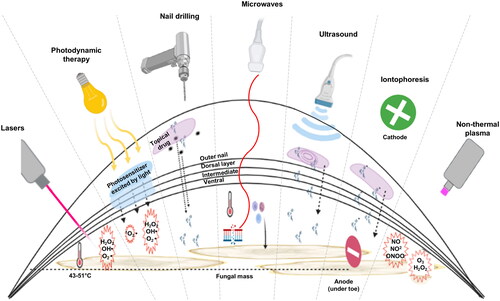 Figure 2. Summary of device mechanisms for the treatment of onychomycosis. Starting from left: Lasers) heat the fungal infection under the nail through transmission as well as generation of reactive oxygen species causing fungal cell damage; photodynamic therapy (PDT)) involves excitation of a photosensitizer by a light source leading to the generation of reactive oxygen species; microdrilling) small holes through the nail to aid the topical antifungal agent to reach the nail bed; microwaves) increase the temperature of the fungus, denaturing its proteins, they also cause DNA damage, and trigger an immune response; ultrasound) uses acoustic streaming to push the active drug through the layers of the nail; iontophoresis) also drives drugs in a topical antifungals through the nail by first applying a charge to the drugs and then introducing an electric field across the affected nail to pull them; non-thermal plasma) in contact with the air generates both reactive oxygen and reactive nitrogen species to damage the fungus.