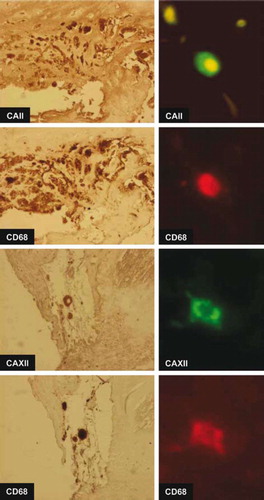 Figure 5. Double immunofluorescence and mirror image section images demonstrating co-localization of CAII and CAXII proteins with CD68 in human atherosclerotic plaques in representative carotid plaques. CAII labeling is cytosolic while CAXII labeling is strong in the cell membrane.