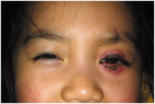 Figure 1. A two-year-old girl with congenital divided eyelid nevus. One month after CO2 laser therapy, most crusts have fallen off, exposing an erythematous wound. Lower eyelid ectropion was also noted.