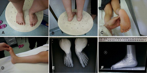 Figure 3. Relapse was identified at 4 years of age for poor brace compliance. Right clubfoot: Dimeglio score =8. (A) Forefoot adductus, (B) No obvious varus deformity, (C) Lateral edge curve, (D) Equinus deformity, (E) Standing anteroposterior views: reduced talocalcaneal angle, (F) Standing lateral views: reduced talocalcaneal angle and flat-top talus.