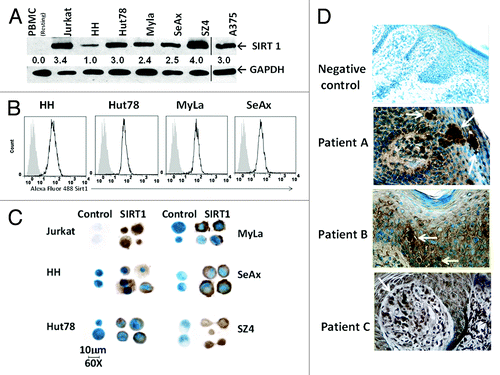 Figure 1. SIRT1 protein is overexpressed in CTCL cells. (A) Immunoblot analysis for endogenous SIRT1 expression was performed using normal blood (resting PBMC), 5 CTCL cell lines (HH, Hut78, MyLa, SeAx, and SZ4), T-ALL Jurkat, and A375 melanoma (the latter from a separate blot and separated by a line). Numbers show the relative density of protein bands normalized to loading control GAPDH. Blots shown are representative of 3 independent experiments. (B) Intracellular SIRT1 was analyzed by flow cytometric analysis. Overlaid curves represent SIRT1 (black line) compared with isotype controls (filled gray). (C) Immunocytochemical staining shows SIRT1 immunoreactivity in CTCL cytopreparations, developed with DAB chromogen and methylene blue counterstain and photographed with Nikon Eclipse Ti microscope and a high-performance CCD camera using with an oil immersion lens at 60× magnification. (D) Immunohistochemical SIRT1 expression in lesional skin from CTCL patients showing clusters of stained tumor cells in epidermis and dermis (white arrow heads). Staining protocol was similar to Figure1C, and images were photographed at 40× magnification using an oil immersion lens.