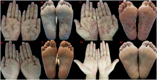Figure 1. Clinical features of the two patients. (A) Palm of patient 1 before using upadacitinib. (B) Sole of patient 1 before using upadacitinib. (C) Palm of patient 2 before using upadacitinib. (D) The sole of patient 2 before using upadacitinib. (E) Palm of patient 1 after using upadacitinib for 20 weeks. (F) Sole of patient 1 after using upadacitinib for 20 weeks. (G) Palm of patient 2 after using upadacitinib for 18 weeks. (H) Sole of patient 2 after using upadacitinib for 18 weeks.