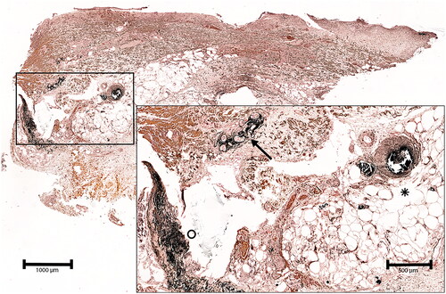 Figure 1. Deep skin biopsy of the left lower leg of a 79 year-old male patient with non-uremic calciphylaxis. The von Kossa stain demonstrates vascular perieccrine calcification (arrow), calcification of a subcutaneous artery and adjacent capillaries (asterisk) as well as diffuse calcification of fibers in the deep dermis.