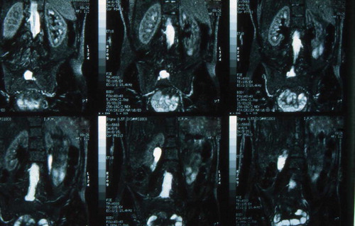 FIGURE 1.  Nuclear magnetic resonance demonstrating moderate hydronefrosis in right and left kidney