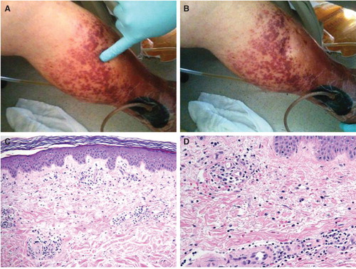 Figure 2. Demonstration of non-blanchability of the purpuric lesions (A and B). Histopathology of skin lesions from the purpuric lesions (C). The epidermis demonstrates no inflammatory changes. Within the papillary dermis there is a mild inflammatory infiltrate associated with extravasated red blood cells (× 100, H&E). The inflammatory infiltrate is composed predominately of lymphocytes with rare eosinophils (D). There are scattered extravasated red blood cells. No neutrophils are present. The vessels show no fibrinoid necrosis or fibrin thrombi (× 200, H&E).