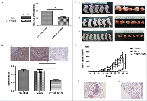 Figure 1. Effects of STK33 on tumor growth in vivo. (A) Infection of STK33-RNAi into Fadu cells led to a significant decrease in STK33 mRNA expression compared with that in the normal Fadu cells. Data represent the mean ± SEM , *p < 0 .05. (B) Gross appearance of tumor-bearing nude mice and the excised tumor specimens at the end of the treatment. Photographs of animals and tumors were representative from each group. a) control group, b) mock group, c) STK33-RNAi group. (C) Tumor volume and formation time of STK33-RNAi cells derived xenografts differed from those of normal and mock cells. STK33-RNAi markedly decreased the volume of the tumor and delayed the formation of the tumor. Data represent the mean ± SEM, *p < 0 .05. (D) Representative images of STK33 IHC staining and correspondingly quantitative analysis in the 3 groups. STK33-RNAi significantly decreased the STK33 expression in the tumor tissue. Data represent the mean ± SEM, *p < 0 .05. (E) Microscopic view of tumor metastasis by HE staining. a) control group, b) STK33-RNAi group.