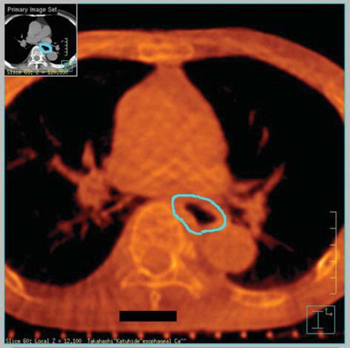 Figure 1. CBCT image of the middle thoracic region, scanned under free respiration and processed after transferring data onto a Pinnacle3 workstation for planning of RT. A case with the outer esophageal wall contoured on the CBCT images (sky-blue contour).