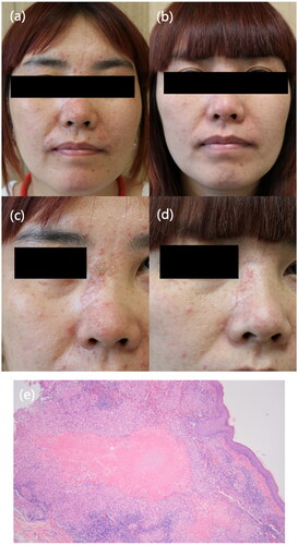 Figure 1. Clinical presentation of Patient 1. (a, c) Multiple erythematous and reddish papules on the patient’s face at baseline. (b, d) The lesions improved after oral tofacitinib treatment. (e) Routine pathology (hematoxylin eosin, original magnification ×20) showing caseating granulomas and lymphocytes infiltrating.