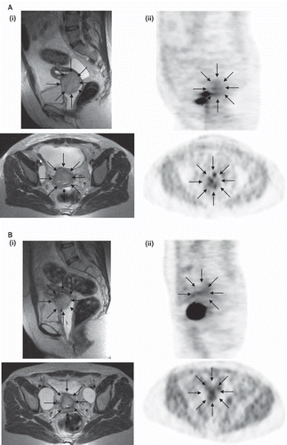 Figure 1. Sagittal and axial MRI (i) and sagittal and axial 18FAZA PET (ii) imaging in a patient with cervical cancer FIGO stage IIb before therapy (A) and during RT (B) (patient number 6). Arrows indicate the tumor on the MRI (i) and the hypoxic areas within the tumor (ii).