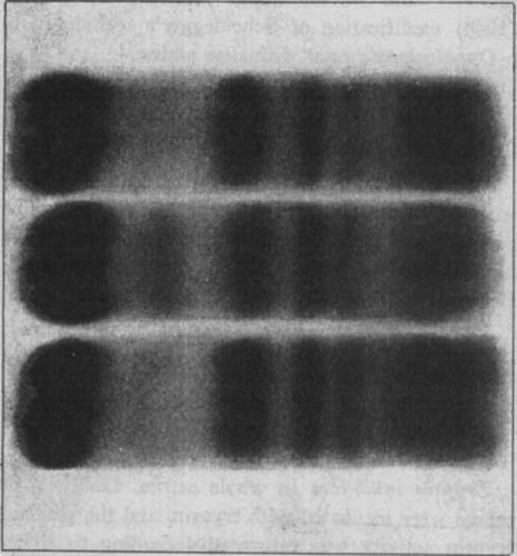 Figure 1.  Paper electrophoretic protein pattern of sera from two patients with α1-antitrypsin deficiency and from a control. Upper: Case No. 2. Middle: Normal. Lower: Case No. 5.