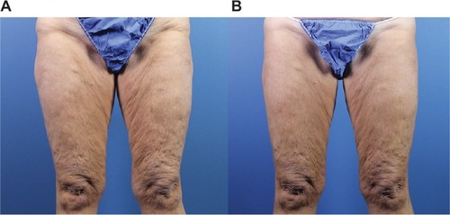 Figure 5 Improvement in anterior thigh cellulite and skin laxity 4 months following laser-assisted subcision (B) compared with baseline (A).
