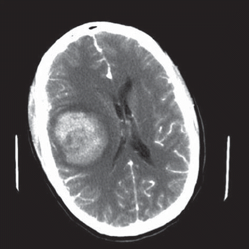 Figure 1. First CT-scan performed after i.v. contrast injection shows a right-sided frontoparietal haemorrhagic lesion (5 × 6 cm) with surrounding oedema, a right-sided temporofrontal subdural haematoma of 7 mm and a marked (12 mm) shift of the midline structures.