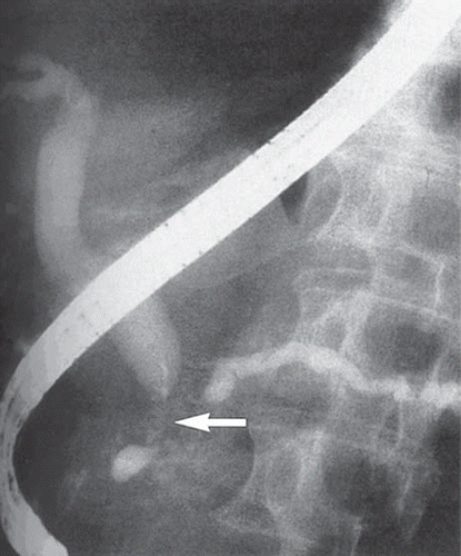Figure 3. ERCP demonstrating a classic “double duct” sign. The arrow shows tumor obstruction of both the bile duct (left) and pancreatic duct (right).