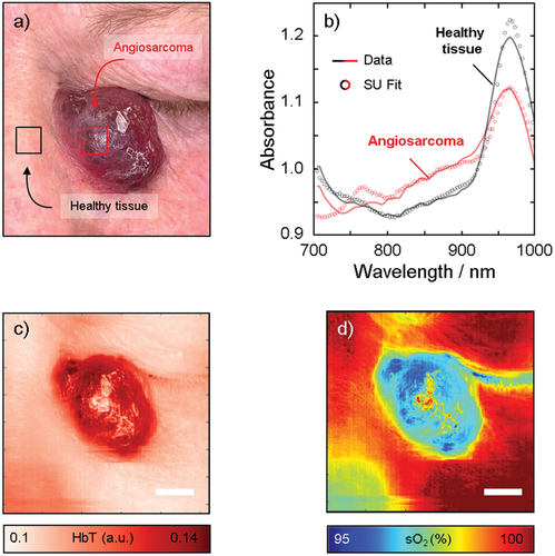 Figure 3. Hyperspectral imaging of the angiosarcoma in vivo with the corresponding photograph (a). The spectra in the tumor and the healthy skin shown in (b) were analyzed in the two regions of interest indicated by the red and black squares in (a). The solid lines indicate the measured spectra and the circles indicate the fit obtained by spectral unmixing (SU) of the measured spectra using the endmembers melanin, HbO2 and HbR, collagen, fat, and water. From the spectral unmixing, we calculate HbT (c) and sO2 (d). Note the increase in HbT and decrease in sO2 in the tumor, suggesting the pooling of deoxygenated blood. Scale bar represents 10mm.