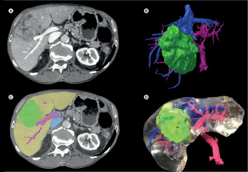Figure 3. 3D printing in hepatobiliary and pancreatic surgery.Development of 3D printed liver models. (A) Raw CT axial image. (B) CT image with segmentation masks overlay (green, tumor; purple, portal vein; blue, inferior vena cava). (C) Surface rendering of segmented meshes. (D) 3D printed liver model.Reproduced with permission from [Citation62] © SpringerLink (2020).