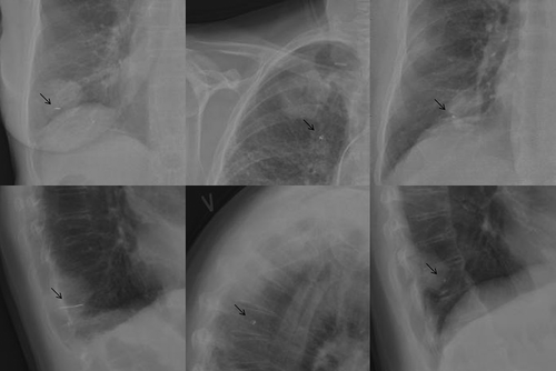 Figure 2. Chest x-rays showing different marker types. Patient 1 had a 2 cm long helical gold marker (VisicoilTM) implanted in the tumour in the right inferior lung lobe (left). Patient 6 had the complex helical platinum marker (Boston Scientific) implanted in the tumour in right superior lung lobe (middle). Note that the marker was placed outside the tumour. The patient had a pacemaker. Patient 11 had the Gold AnchorTM marker implanted in the tumour in the right inferior lobe (right). The arrows indicate the position of the markers.