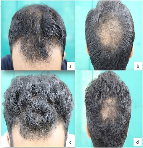 Figure 2. Baseline (a,b) and week 24 (c,d) global photographs of a responder with AGA in Minoxidil group.