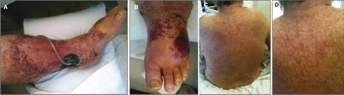 Figure 1. Palpable purpuric rash on the left lower extremity (A and B) and back (C and D) following antibiotic therapy.