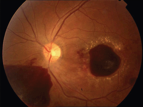 FIGURE 3  Fundus picture of the left eye 1 month later. Note new perifoveal hard exudates and subhyaloid hemorrhages in inferonasal and premacular areas.
