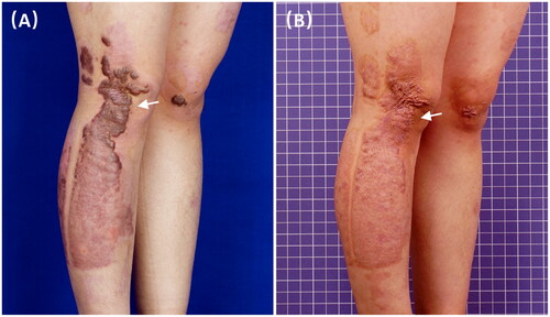 Figure 2. A 21-year-old burn female with hypertrophic scars on lower limbs received three CO2-IPL treatments showing marked improvement in color, thickness and texture.