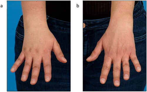Figure 4. Follow-up 2 years after surgery and 1.5 years after initial diagnosis of lymphedema of the right arm (a) right hand, (b) left hand).