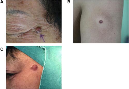 Figure 1 (A) Case 1, lesion presented as a reddish-brown nodule on the head and face, with uneven pigment and regression phenomenon. (B) Case 2, lesion presented as an isolated red papule on the left upper limb, without pigmentation, mimicking the “dermatofibroma”. (C) Case 3, lesion presented as a soybean-sized reddish nodule on the left corner of the eye with uneven pigment.