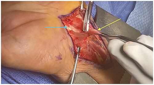 Figure 4. Intraoperative image of the left wrist. Tenosynovectomy is performed demonstrating extensive tenosynovitis (yellow arrow). The flexor tendons underlying the tenosynovium are seen in the bed of the wound (blue arrow). The retractor at the bottom of the image is protecting the median nerve from inadvertent injury.