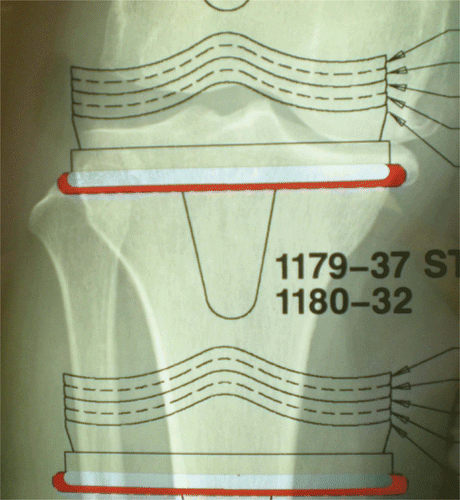 Figure 1. Conventional 2D templating: anteroposterior view of the knee demonstrating templating of the tibia.