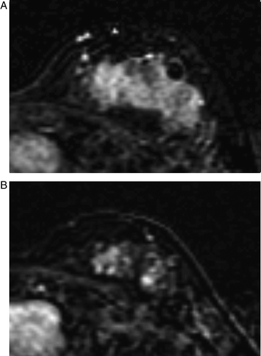 Figure 4.  MRI before (A) and after (B) chemotherapy in a case showing nest pattern of the tumor response. The mass, measuring as 5.3×5.0 cm before chemotherapy (A), decreased slightly to 4.0×3.7 cm and showed a nest pattern on MRI after chemotherapy (B). A single inclusive measurement was given owing to multifocal enhancement after chemotherapy. The pathologic finding was a 1.8 cm, invasive ductal cancer with extensive intraductal components in a diffuse, unmeasurable, necrotic grayish area. MRI overestimated the size of the residual invasive tumor because it could not differentiate invasive from intraductal cancers
