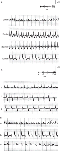 Figure 4.  ECG traces showing (A) the effect of direct perfusion of isolated toad heart with EtOAc extract solution (0.2 μg/mL) of C. procera on the electrocardiogram of isolated toad heart at different time intervals; (B) the effect of adding atropine (4 μg/mL) after EtOAc extract application, and (C) the effect of adding verapamil (5 μg/mL) after EtOAc extract application (a) before treatment, (b) 20 min after treatment, (c) after adding blocker.