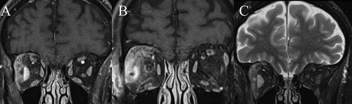 Figure 2. Coronal MRI orbits of right orbital cellulitis. A, demonstrates contrast-enhancement of the enlarged right lateral rectus and adjacent supero-lateral extraconal fat on CE FS T1. B, demonstrates the prior stated changes, along with the loss of distinct margins of the lateral rectus, and peri-neuritis on CE FS T1. C, demonstrates high T2 signal of the respective lateral rectus and orbital fat.
