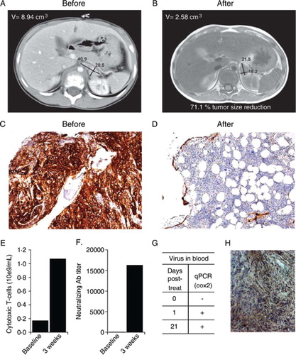 Figure 1. A chemotherapy resistant case of neuroblastoma was treated with oncolytic adenovirus Ad5/3-Cox2L-D24. A) Computer tomography of primary tumor before oncolytic virus treatment. B) Magnetic resonance imaging one month after treatment shows moderate decrease of the primary tumor and complete regression of the lymph nodes. C) Before treatment, bone marrow was almost completely infiltrated by neuroblastoma cells (CD56 staining, brown, 10x), (monoclonal mouse anti-SCLC (CD56, N-CAM), Clone 123C3, Invitrogen, CA, USA). D) Few neuroblastoma cells in bone marrow three months after oncolytic virus treatment (10x). E) Oncolytic virus treatment increased the number of CD3+/CD8+ cytotoxic T-cells in blood. F) Anti-adenoviral neutralizing antibodies were induced. G) Virus was detected in blood for three weeks after treatment. H) Immunohistochemistry indicated intermediate Cox2 expression (brown, 20x) in tumor cells (monoclonal mouse anti-human Cox-2, Clone CX229, Cayman Chemical, MI, USA).