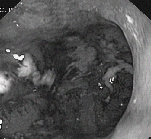 Fig. 1.  Image during oesophagogastroduodenoscopy showing the antral region of the stomach with inflammation and necrotic lesions of the mucosal surfaces with ulceration.