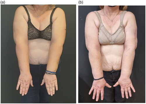Figure 4. (a) Preoperative image of upper extremities. (b) Postoperative image of upper extremities.