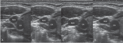 Figure 3. Ultrasound images of cross sectional area of RIJV and relative positions of the RIJV and CA. (A) >30° left head rotation, (B) <30° left head rotation, (C) Neutral position, (D) <30° right head rotation. RIJV, right internal jugular vein; CA, carotid artery.